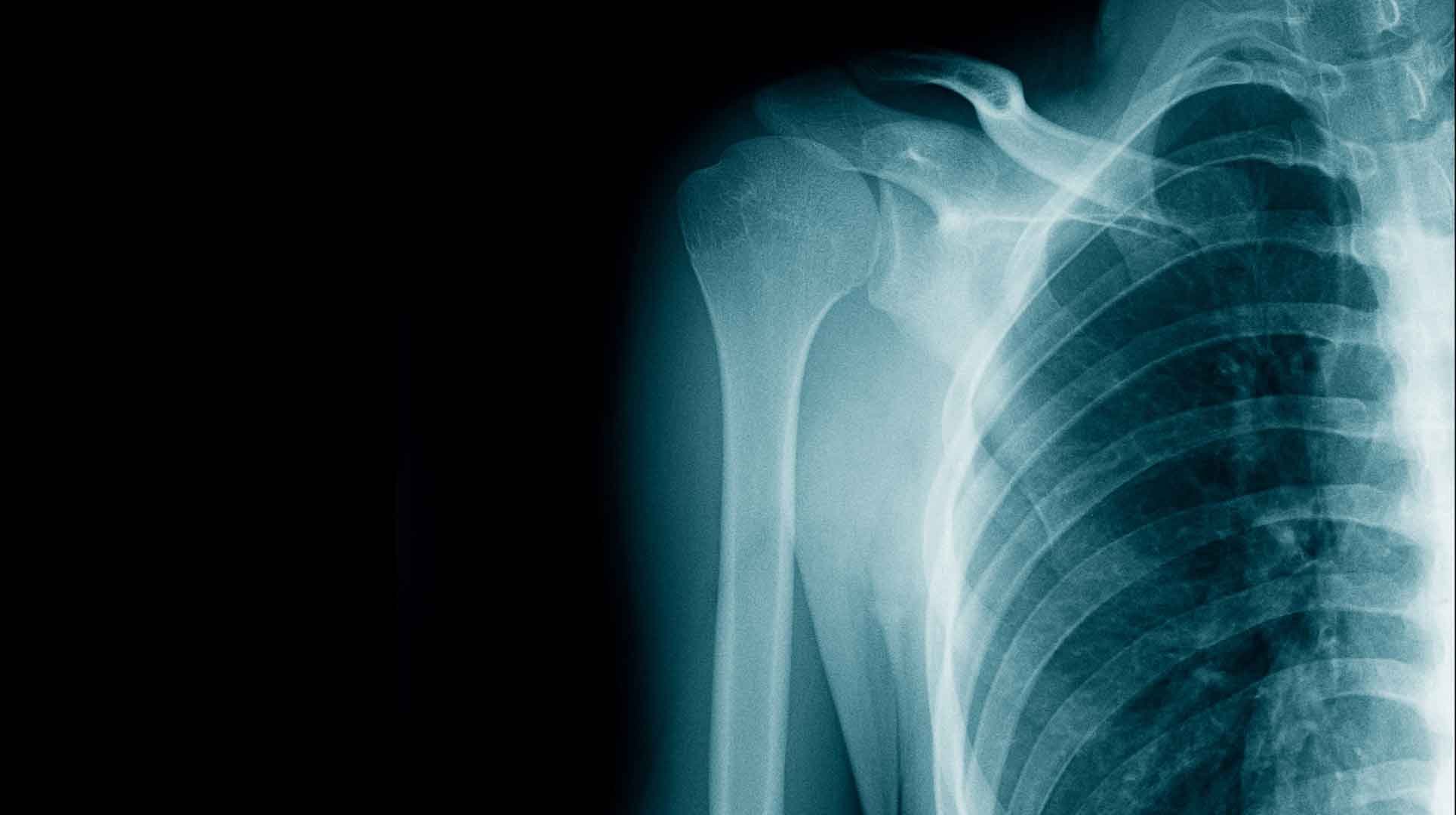 X-ray image of shoulder